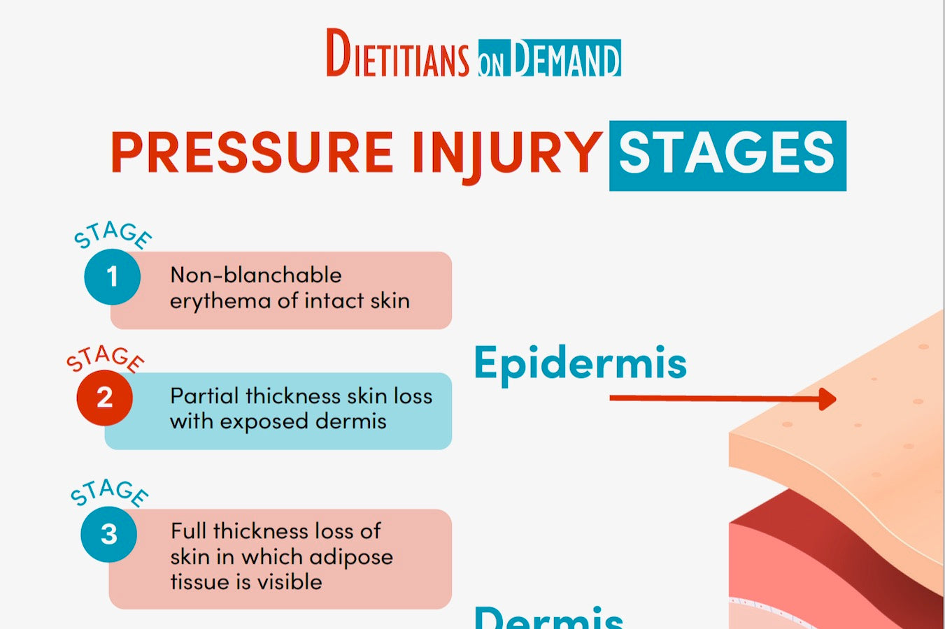 Pressure Injury Stages | Infographic – Dietitians On Demand